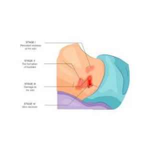 ป้องกันแผลกดทับ Anti Bedsores